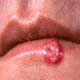 Cold Sores/ Fever Blisters / Recurrent Herpes Labialis