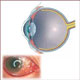Conjunctivitis / Pink Eye