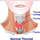 Hyperthyroidism / Thyroiditis / Graves Disease
