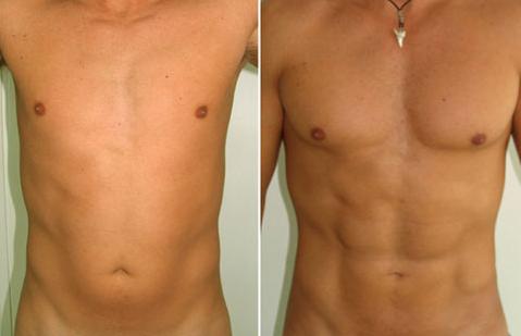 ABDOMINAL LIPOSUCTION IN  MALE BEFORE & AFTER