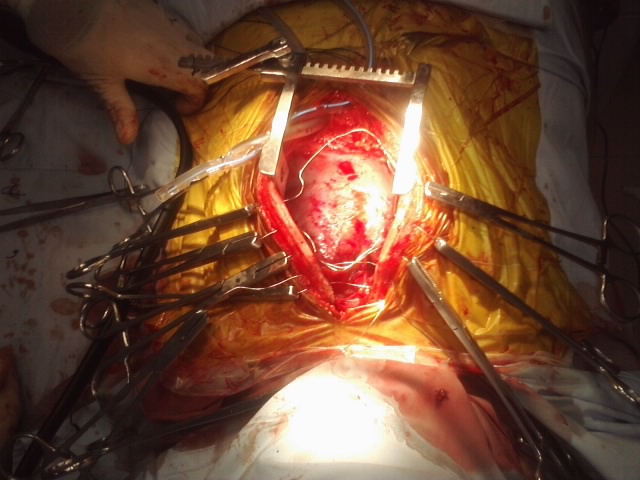 cardiac surgery
