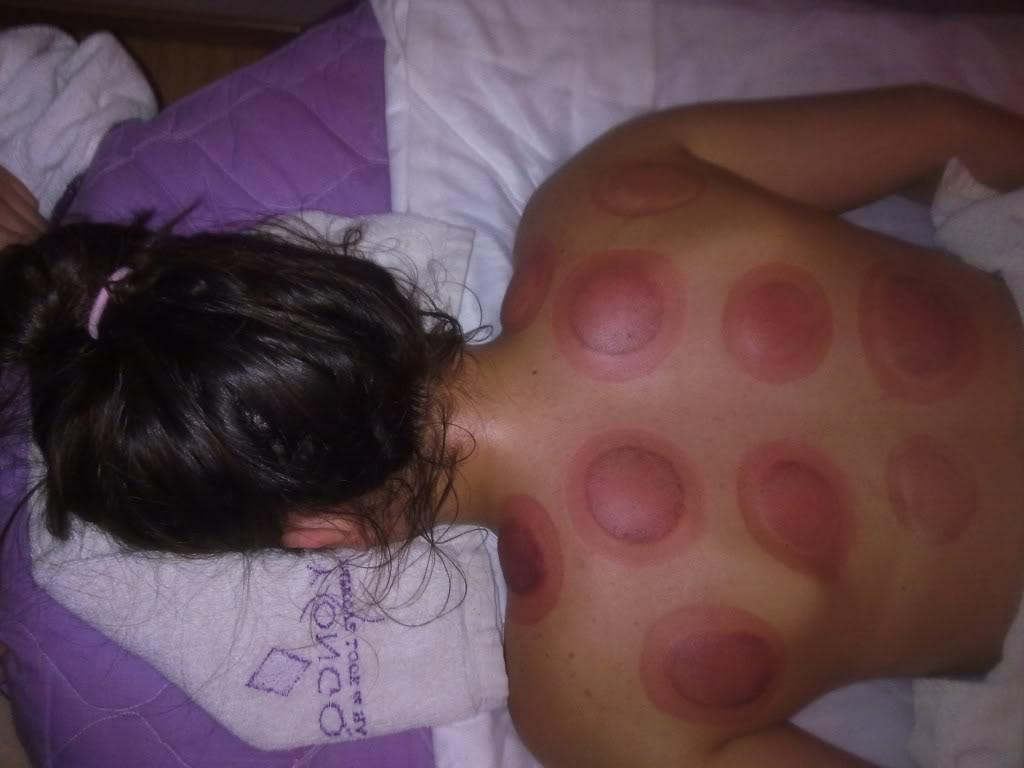 Cupping Therapy Takes Pain Away