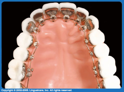 Custom lingual braces