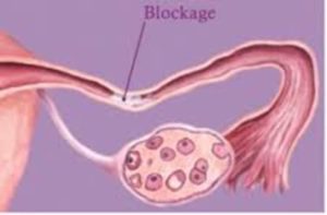Diagnosis and management of ectopic pregnancy