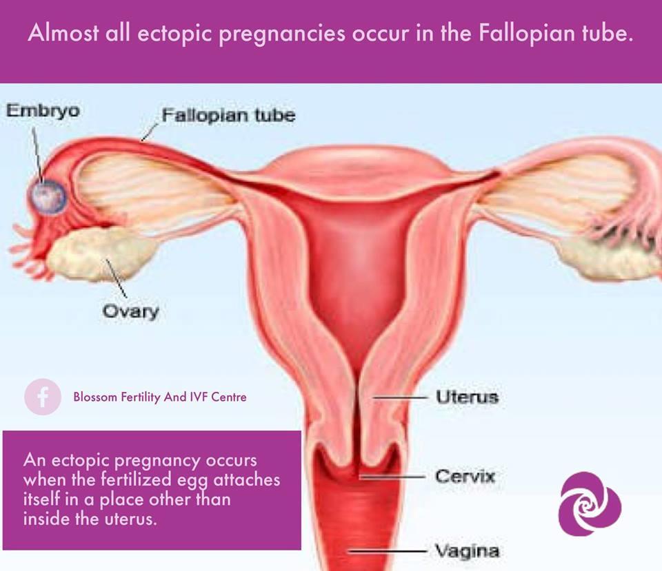 Ectopic pregnancy