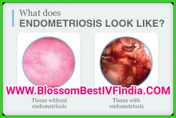 Endometriosis with Dr.Rupal Shah