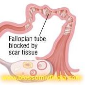 Fallopian Tube Blockage