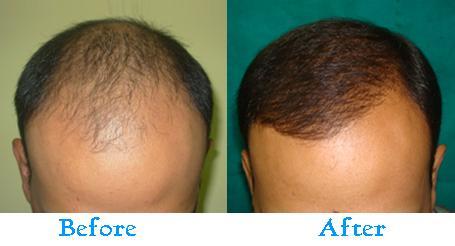 Hair transplantation After before Images