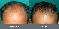 Hair Transplantation Before After Images