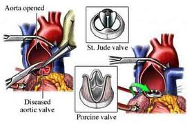 Low Cost Beneficial Cardiac Surgery India