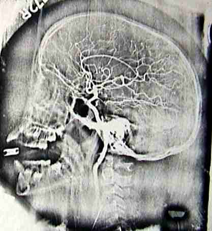 Photostat copy of neuroangiography developed by me while working at AIIMS, New Delhi. 