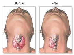 Thyroidectomy Surgery Benefits India