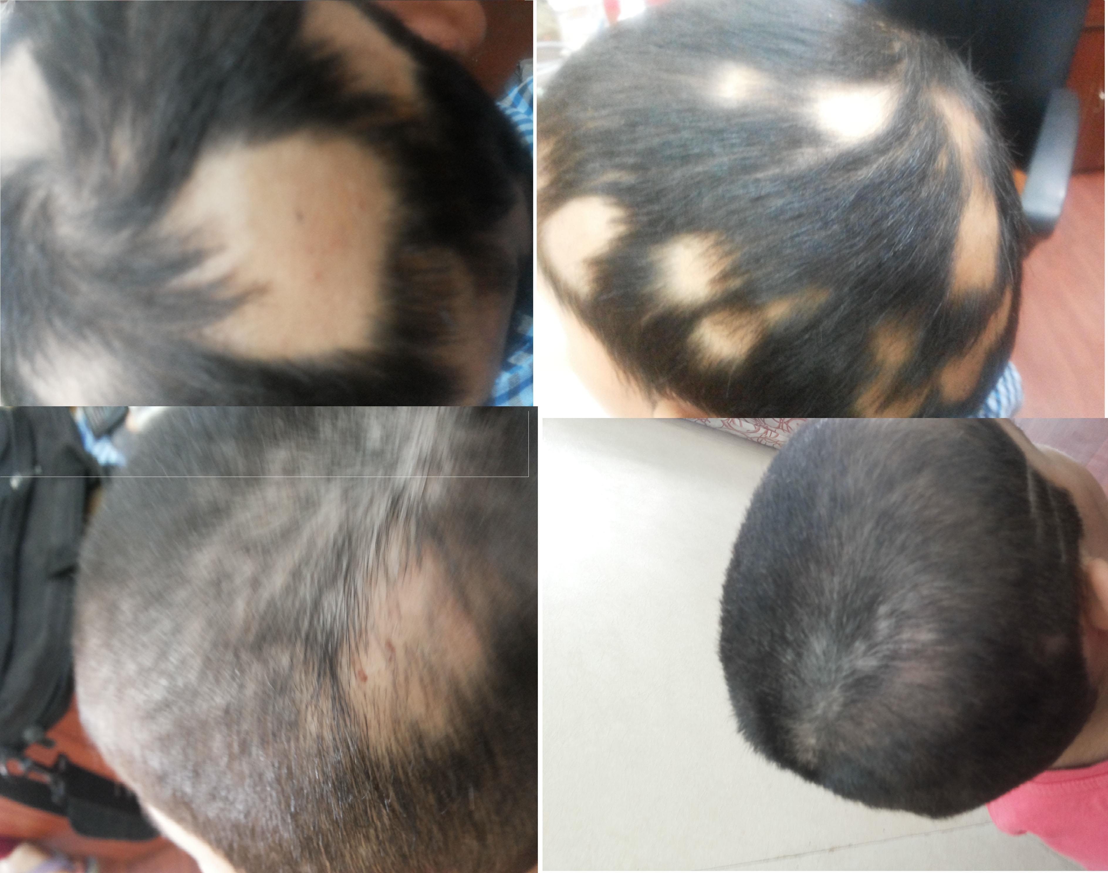 alopecia areata cured